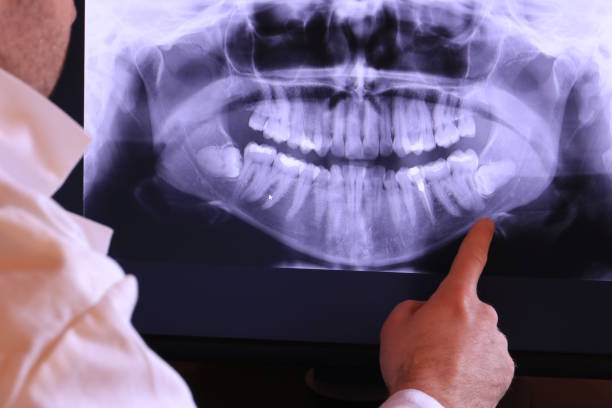 Best Emergency Tooth Extraction in Frederick, OK